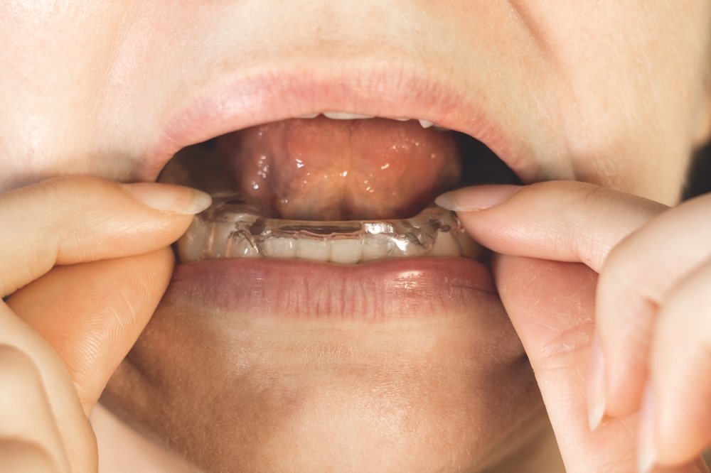 A close-up of a person placing a clear custom oral appliance in their mouth as the treatment for TMJ disorder.