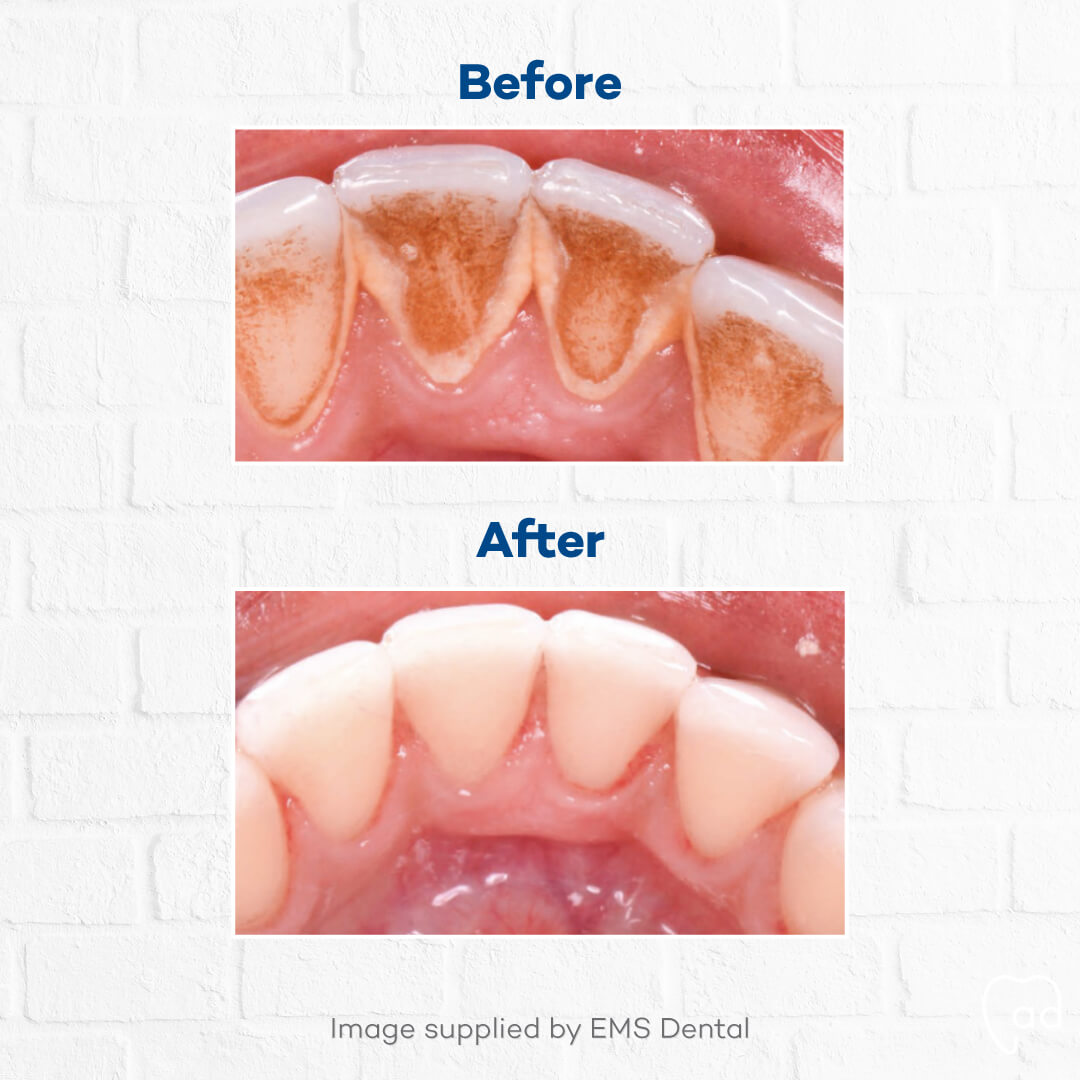 Oral Health Therapist Sarah performing a gentle dental cleaning for a patient at Admire Dentistry Arana Hills.