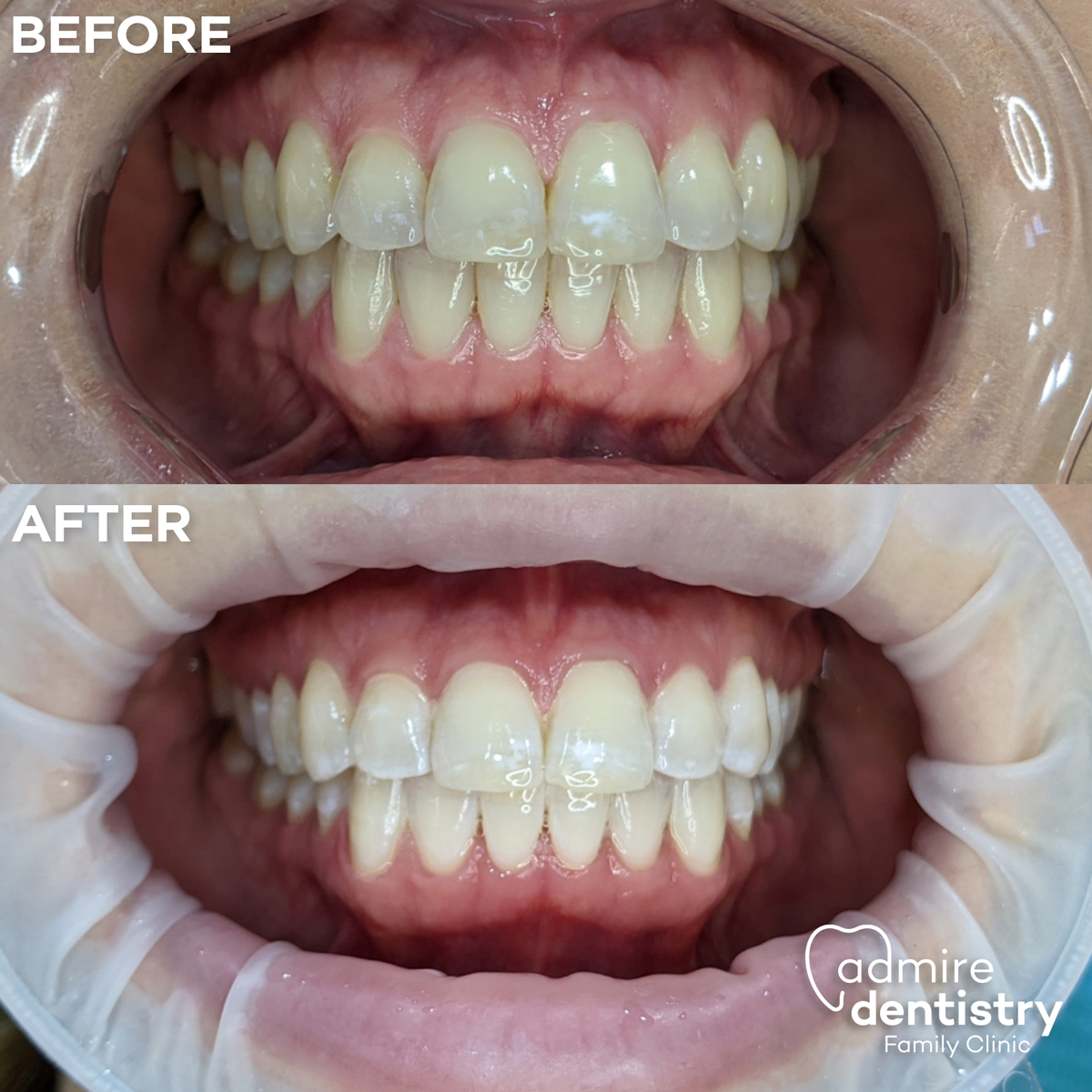 Before and after close-up comparison showcasing the noticeable transformation of a patient's smile after professional teeth whitening treatment.