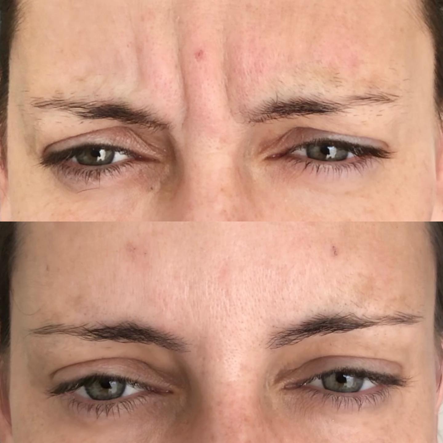 Before and after comparison of a patient's forehead showing the visible reduction of dynamic wrinkles and fine lines following a cosmetic treatment.