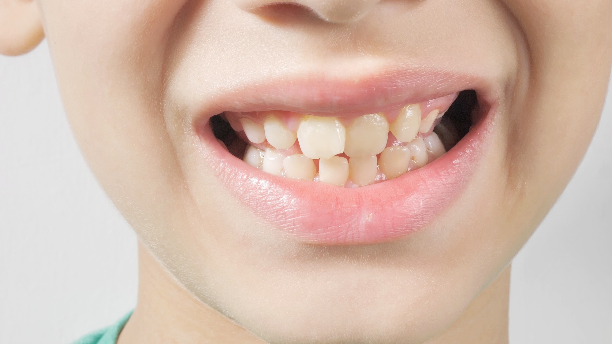 Close up view of a child's smile showing crowded teeth and misalignment caused by restricted jaw growth.