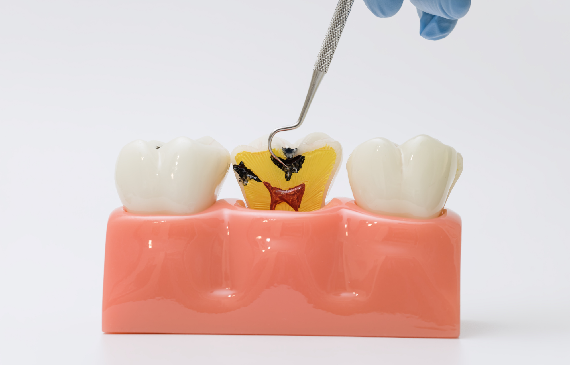Dental model displaying tooth decay and exposed inner tooth layers. 